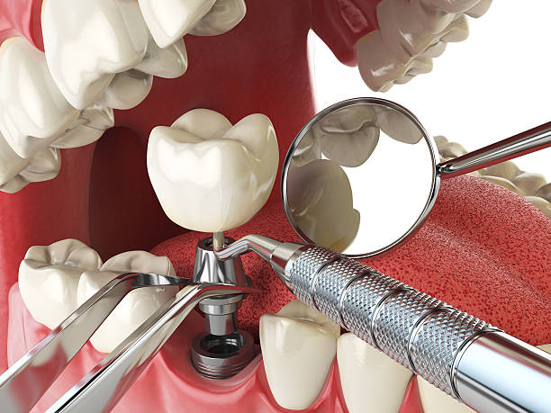 Best Emergency Treatment for Dental Infections or Abscesses in Roseville, CA